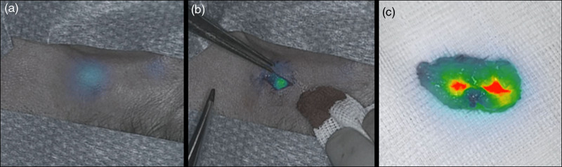 Transcutaneous sentinel lymph node detection in skin melanoma with near-infrared fluorescence imaging using indocyanine green.