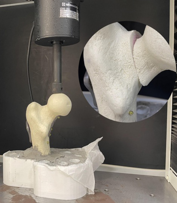 Biomechanical comparison of locking femoral neck plate versus cannulated screws with or without a medial buttress plate in Pauwels type 3 femoral neck fractures.