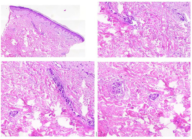 Pregnancy-Related Morphea: A Case Report.