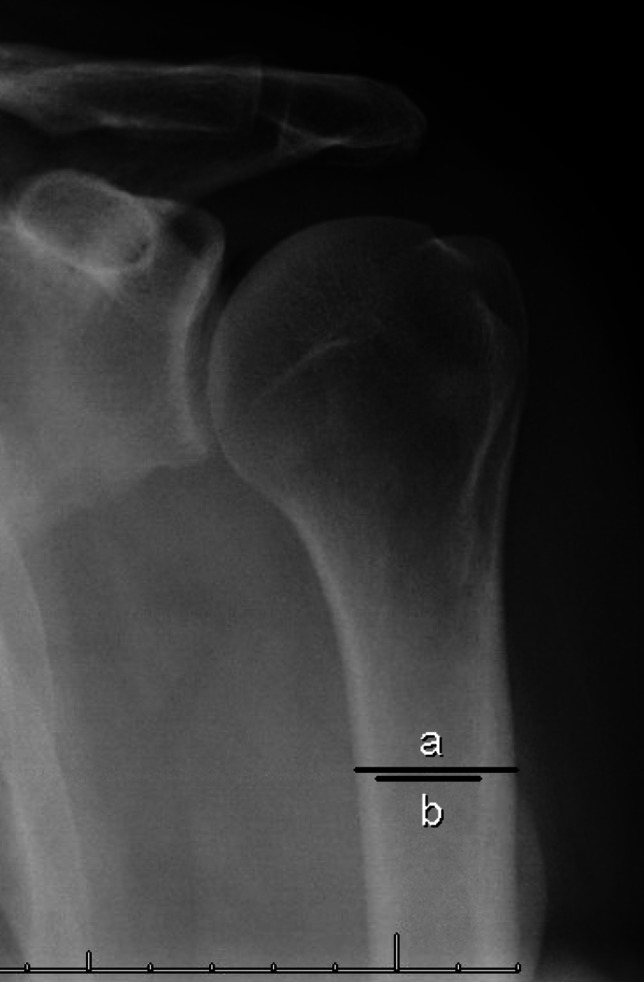Osteoporosis Management for Shoulder Surgeons.
