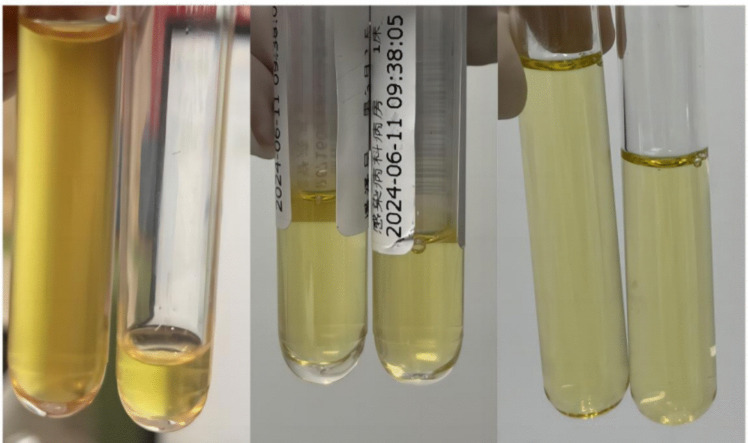 Subarachnoid puncture via the anterior fontanelle with intrathecal vancomycin for refractory purulent meningitis: a pediatric case report.