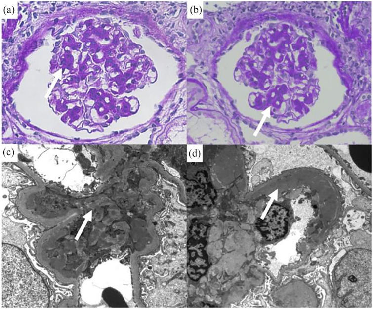 Immune-Complex Mediated Mesangial Proliferative Glomerulonephritis with Full-House Pattern Observed During Treatment of Immune Thrombocytopenic Purpura.