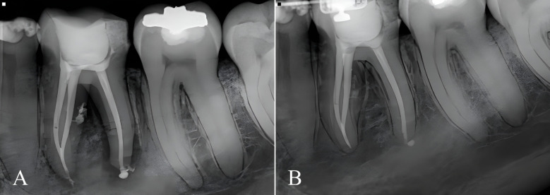Twelve-month healing rates after endodontic therapy with foraminal cleaning using 2% chlorhexidine in mandibular molars diagnosed with apical periodontitis: a prospective clinical study.