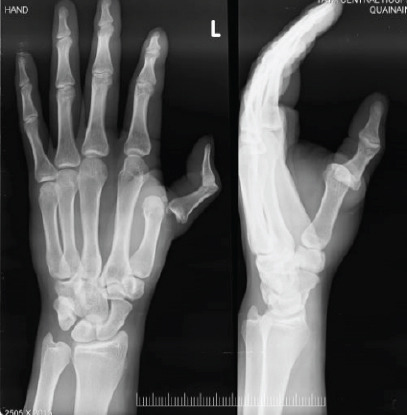 Metacarpophalangeal Joint Dislocations Two Cases, Two Stories.