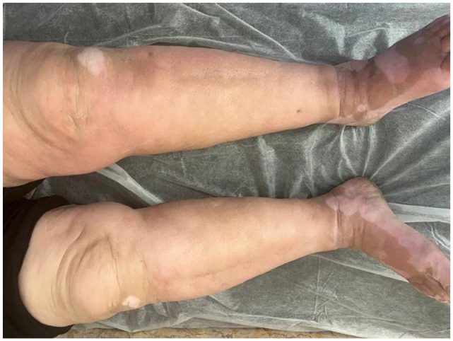 Pregnancy-Related Morphea: A Case Report.