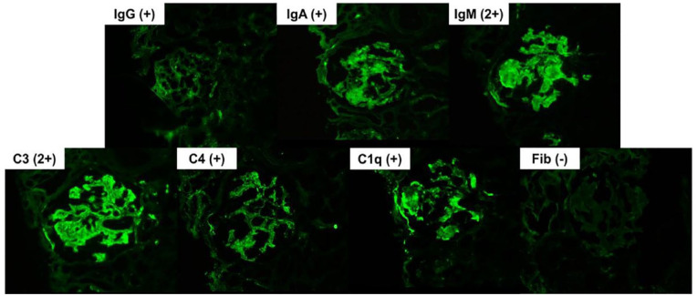 Immune-Complex Mediated Mesangial Proliferative Glomerulonephritis with Full-House Pattern Observed During Treatment of Immune Thrombocytopenic Purpura.