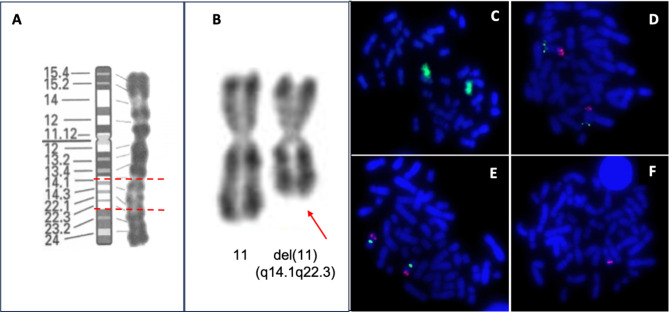 Interstitial 11q deletion in a patient with Sprengel's deformity: a case report and review of the literature.