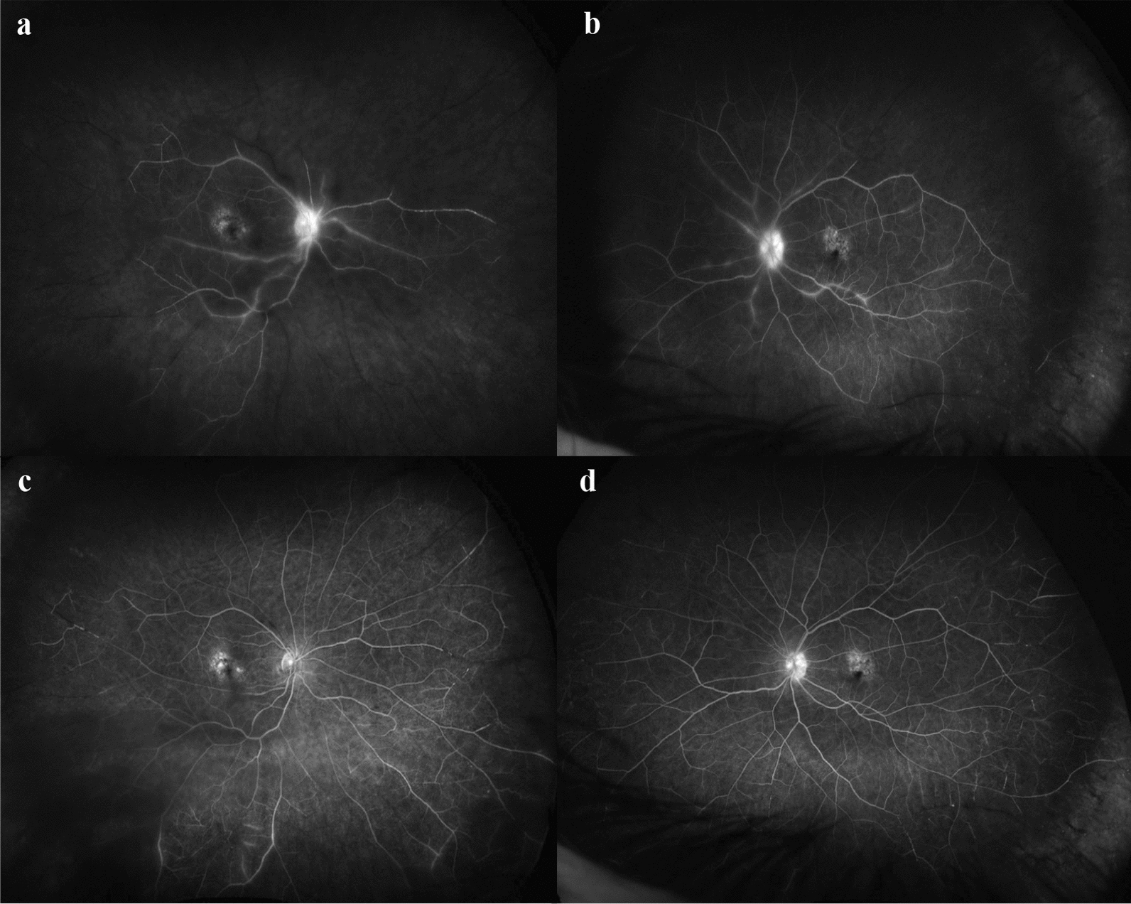 Bilateral occlusive retinal vasculitis secondary to intravitreal faricimab injection: a case report and review of literature.