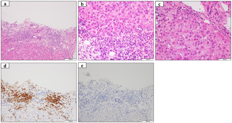 Hepatitis C virus-related hepatitis flare after immunochemotherapy in a patient with follicular lymphoma.