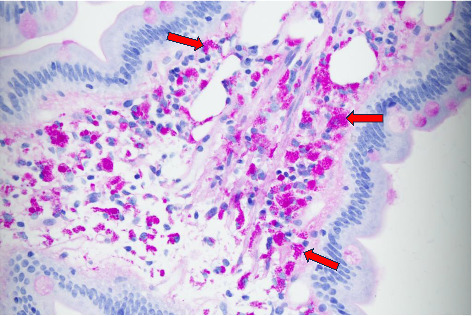 An Incidental Finding of Whipple's Disease Masquerading as Nonspecific, Long-Standing Symptoms.
