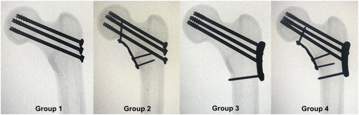Biomechanical comparison of locking femoral neck plate versus cannulated screws with or without a medial buttress plate in Pauwels type 3 femoral neck fractures.