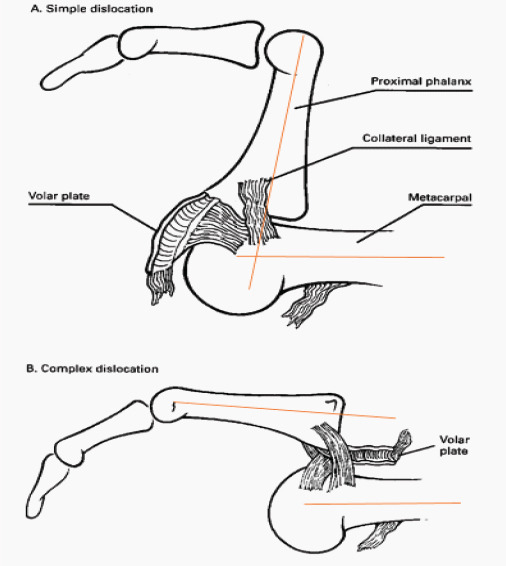 Metacarpophalangeal Joint Dislocations Two Cases, Two Stories.