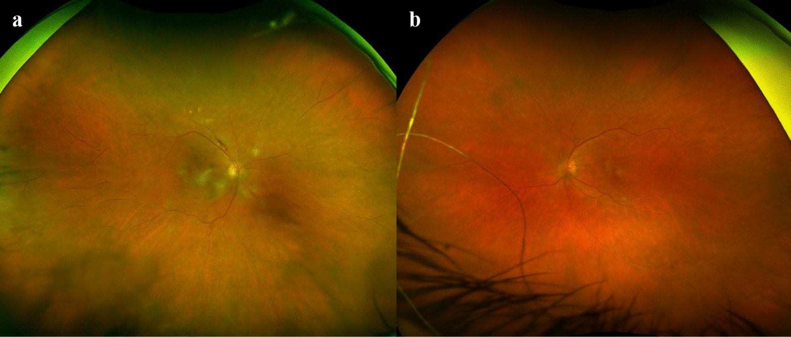 Bilateral occlusive retinal vasculitis secondary to intravitreal faricimab injection: a case report and review of literature.