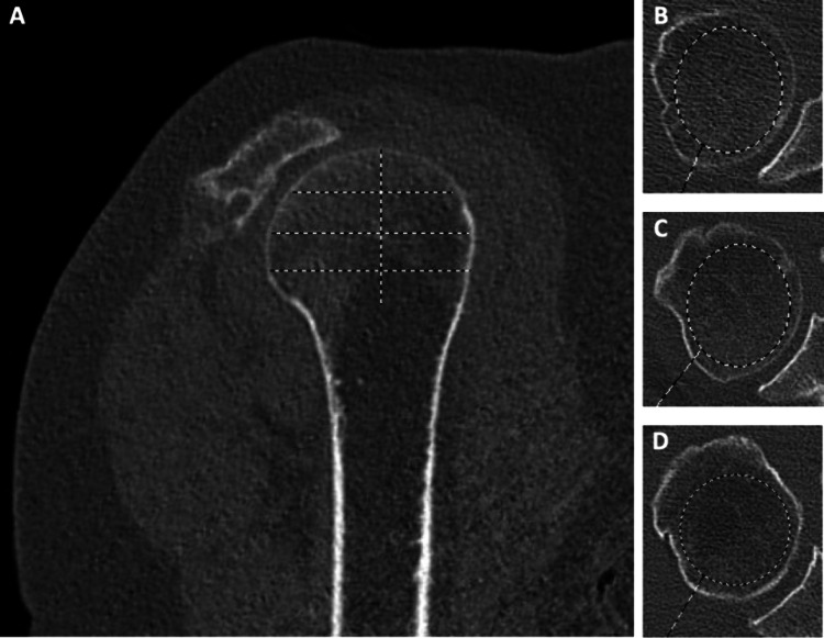 Osteoporosis Management for Shoulder Surgeons.
