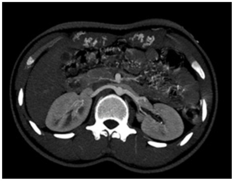 A case of a young man with secondary hypertension.