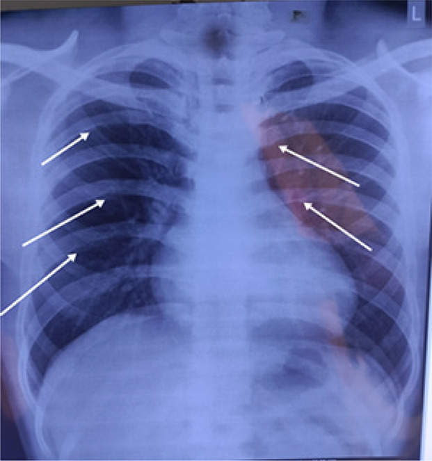 A case of a young man with secondary hypertension.