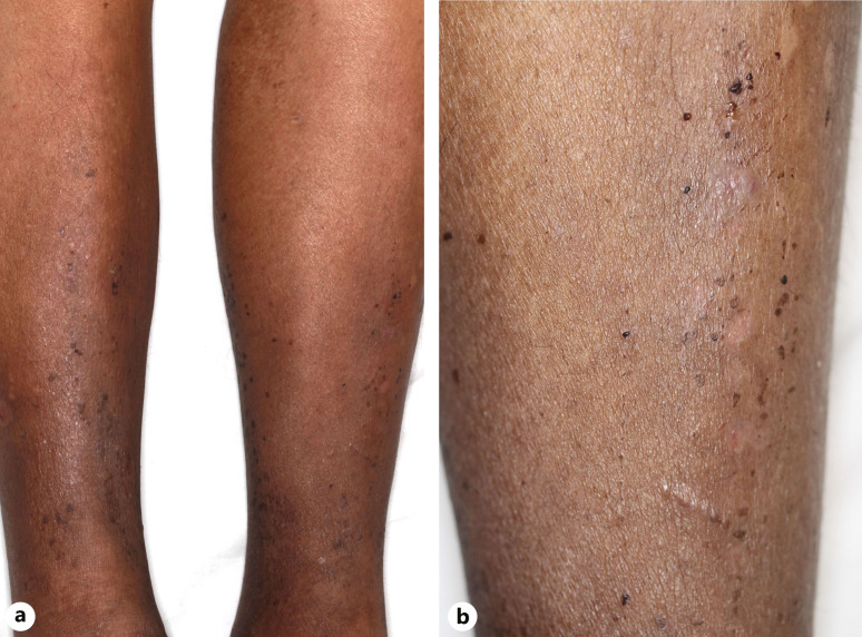 Atypical Bilateral Hyperpigmented Macules on the Lower Legs Possibly due to Cyclophosphamide.