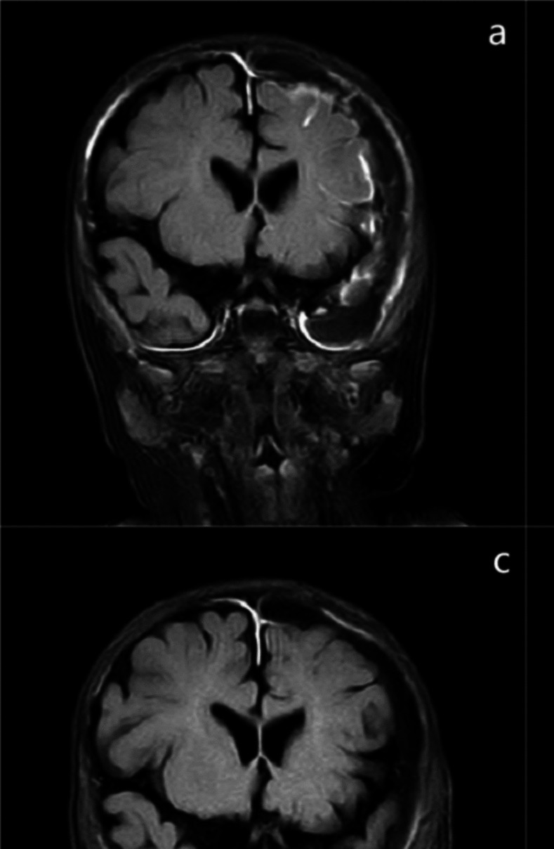 Subarachnoid puncture via the anterior fontanelle with intrathecal vancomycin for refractory purulent meningitis: a pediatric case report.