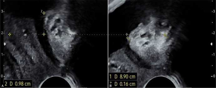 Correlation analysis of selected anatomical and functional parameters of the urethra, assessed through ultrasound and urodynamic examinations.