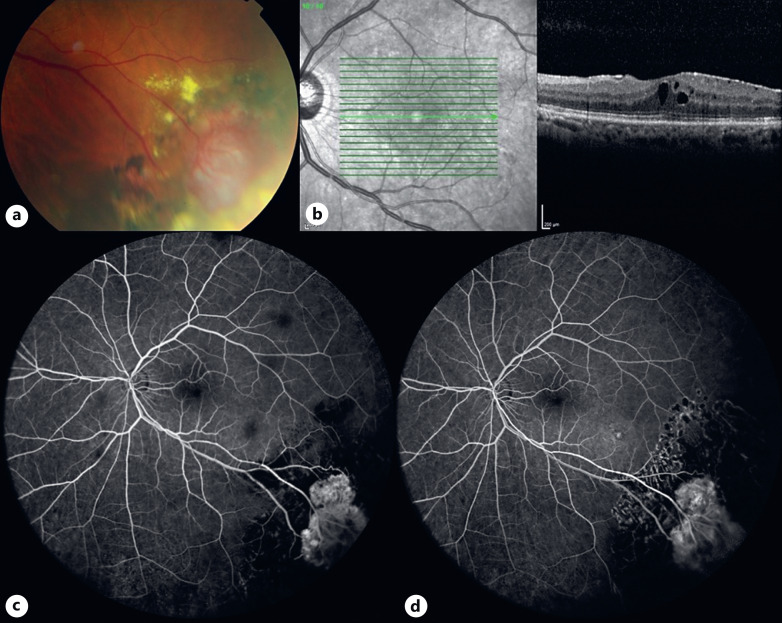 Vasoproliferative Retinal Tumors: Manifestations, Management, and Outcomes in a Case Series.