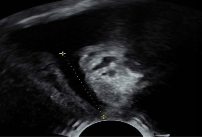 Correlation analysis of selected anatomical and functional parameters of the urethra, assessed through ultrasound and urodynamic examinations.