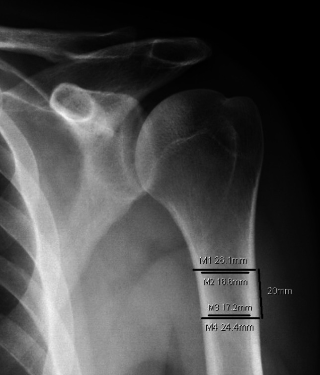 Osteoporosis Management for Shoulder Surgeons.