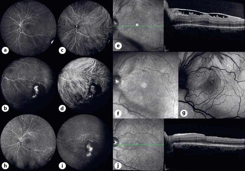 Vasoproliferative Retinal Tumors: Manifestations, Management, and Outcomes in a Case Series.