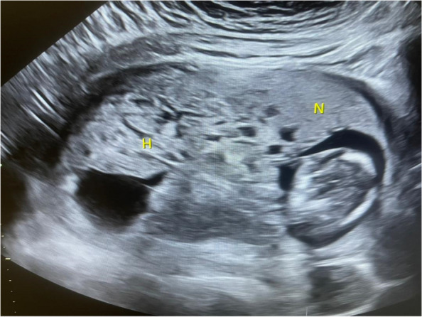 Diploid fetus with partially triploid placenta: case presentation and management strategy.