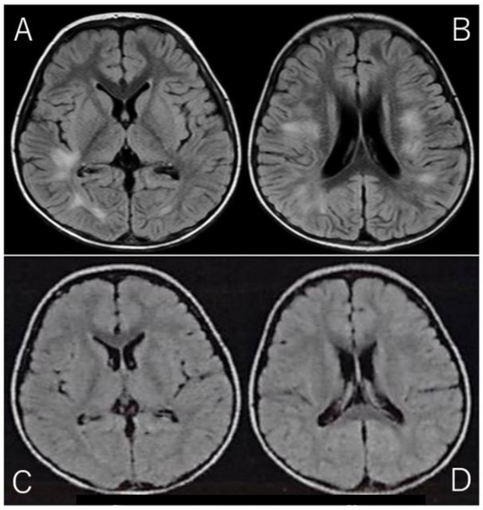 Pediatric Acute Disseminated Encephalomyelitis Triggered by Concurrent Administration of Seasonal and H1N1 Influenza Vaccines: A Case Report and Review.