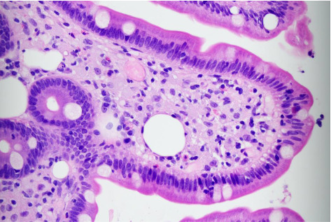An Incidental Finding of Whipple's Disease Masquerading as Nonspecific, Long-Standing Symptoms.