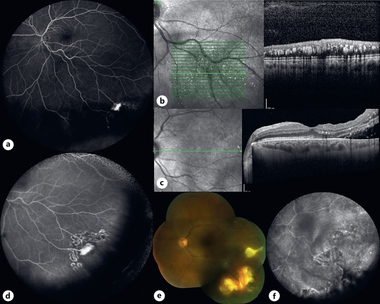 Vasoproliferative Retinal Tumors: Manifestations, Management, and Outcomes in a Case Series.