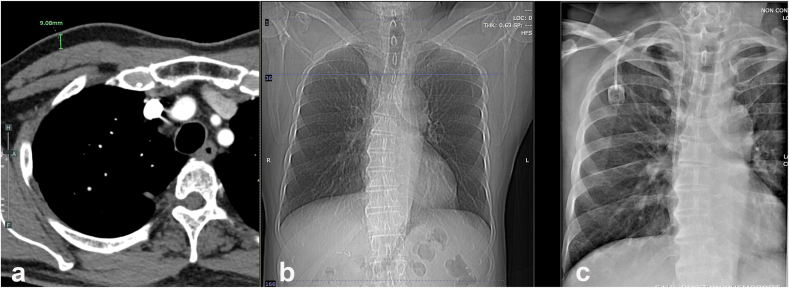 The correlation between subcutaneous fat thickness and the incidence of chemoport-related infection