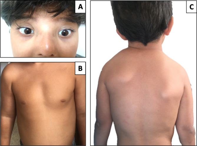 Interstitial 11q deletion in a patient with Sprengel's deformity: a case report and review of the literature.