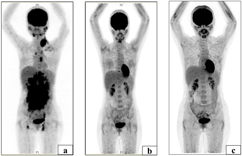 Hepatitis C virus-related hepatitis flare after immunochemotherapy in a patient with follicular lymphoma.