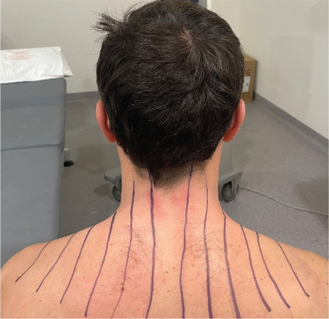 The Effect of Intradermal Injection with Two Different Injection Techniques on Pain and Functional Status in Patients with Chronic Nonspecific Neck Pain.