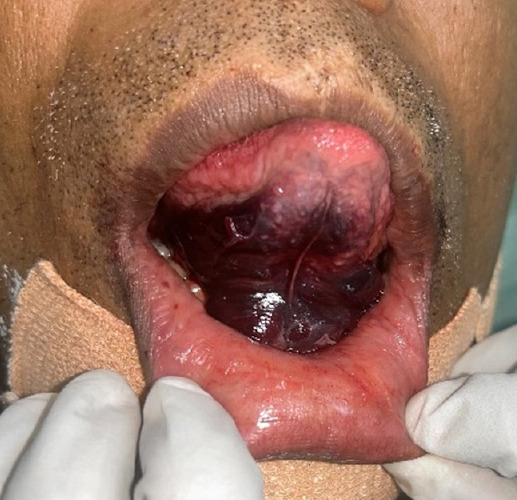 Sublingual hematoma as a complication of mandibular midline osteotomy: a case report and literature review.