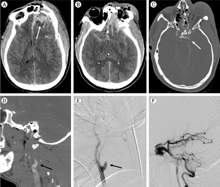 Deconstructive repair of a direct carotid-cavernous fistula via a posterior circulation retrograde approach.