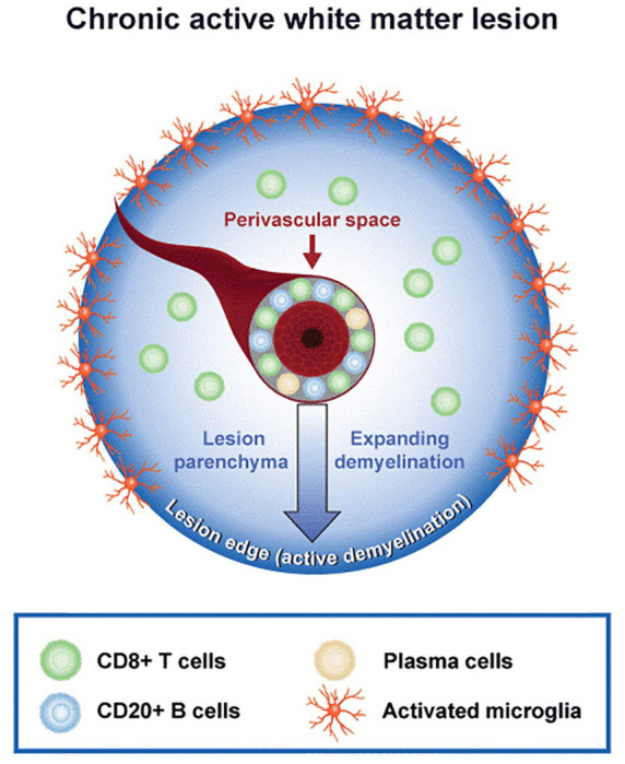 Chronic active lesions in multiple sclerosis: classification, terminology, and clinical significance.