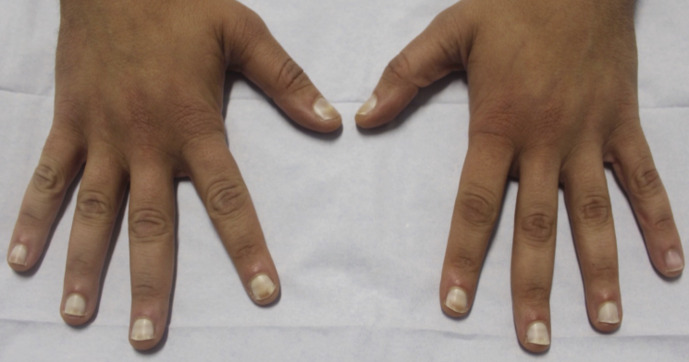 Treatment of Hereditary Leukonychia with Intramatricial Triamcinolone: A Case Report.