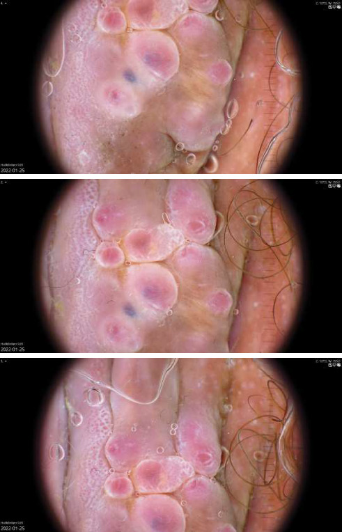 Dermoscopic Features of Cutaneous Endometriosis Arising in a Cesarean Scar: A Case Report.