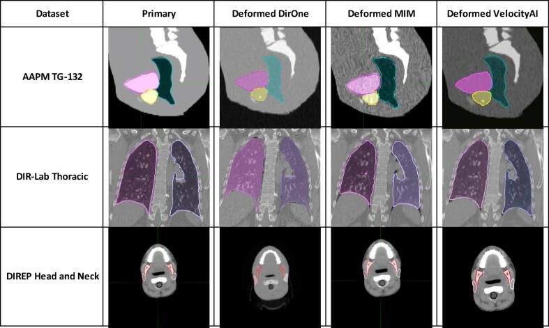 Benchmarking and performance evaluation of a novel deformable image registration software for radiotherapy CT images