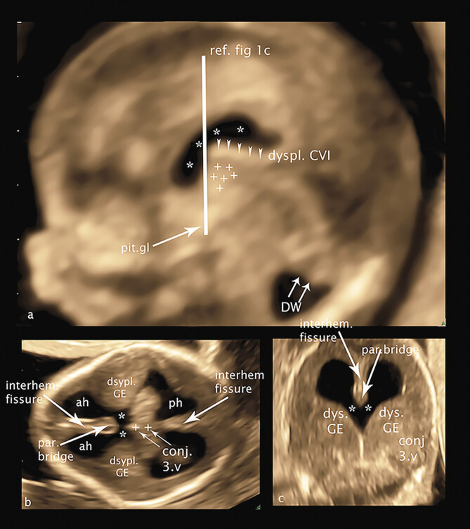 Detailed Analysis of Fetal Malformations of the Supratentorial Structures of the Brain in High-Risk Pregnancies at 12-14 Gestational Weeks by Transvaginal 3D Ultrasound Examination.