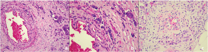 Perivascular Invasion: A Promising Prognostic Parameter for Breast Cancer.