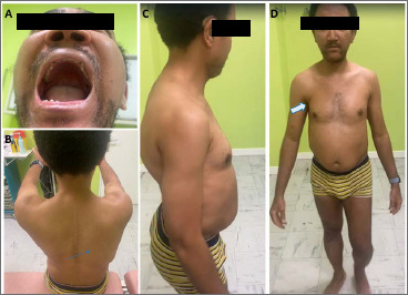 Congenital tubular aggregates myopathy associated with central nervous system involvement: description of a case.