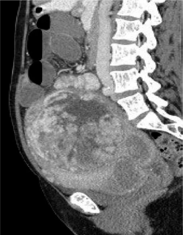 Small bowel obstruction secondary to uterine fibroids: a case presentation.