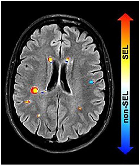 Chronic active lesions in multiple sclerosis: classification, terminology, and clinical significance.