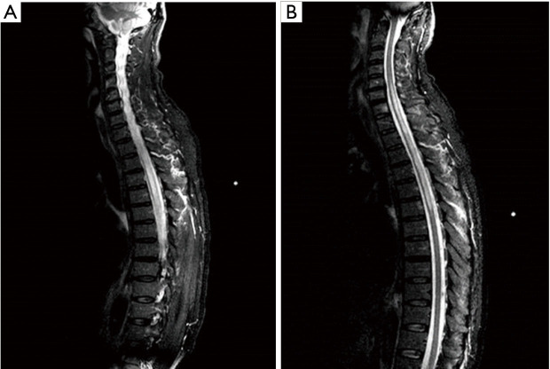 AQP4 antibody-seropositive neuromyelitis optica spectrum disorder in a patient with mixed connective tissue disease: a case report.