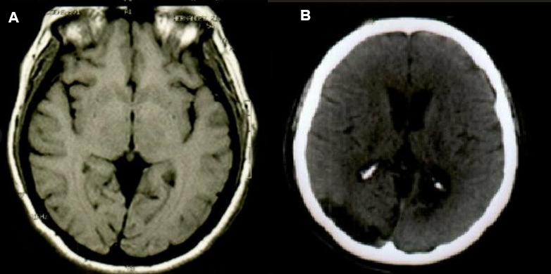 Brain metastases in a patient with antecedent of cardiac myxoma: a case report and review of literature
