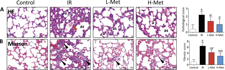 The Effect of Metformin on Radiation-Induced Lung Fibrosis in Mice.