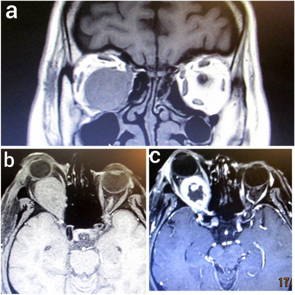 A case report and literature review of rare isolated metastatic papillary thyroid carcinoma in the orbit.